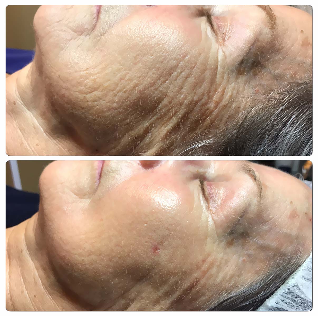 Hudvardssalongen-dermapen-before-efter-1-behandling
